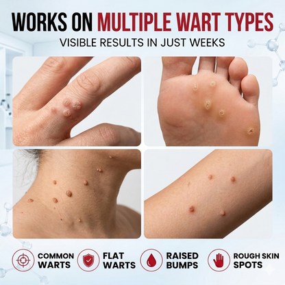 Remove Stubborn Warts Without Painful Treatments-9YB